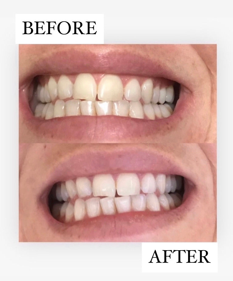 Teeth Whitening Refill Pack